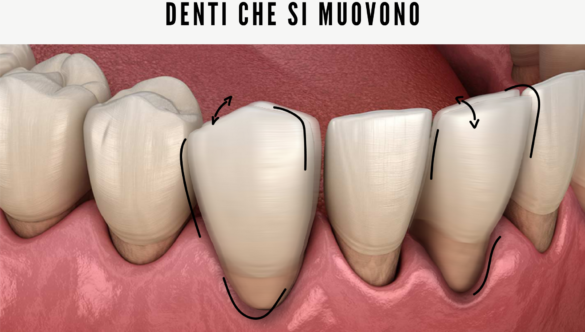 Mobilità Dentale: i miei denti si muovono, cosa significa? Quali sono le cause?