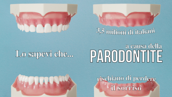 Caduta Denti: 3,5 milioni di italiani rischiano di perdere il sorriso