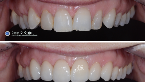 Dental Aesthetics – Application of Dental Veneers
