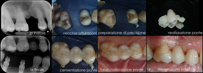 dente mancante sostituzione ponte su intarsi